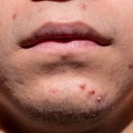 acne-6822174_1280